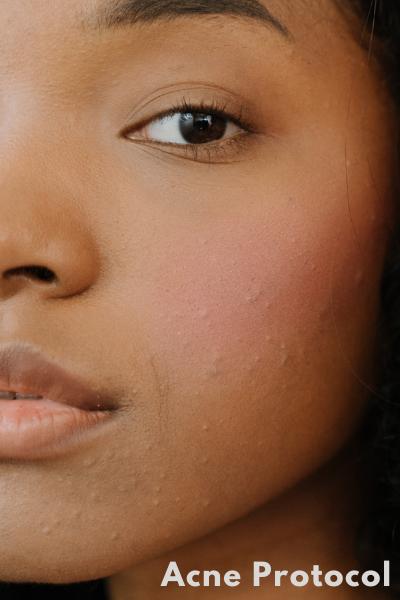Acne Protocol – BE beauty & wellness